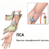 PSA при раке простаты в Израиле Простатический специфический антиген