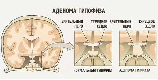 Аденома гипофиза лечение аденомы гипофиза в Израиле