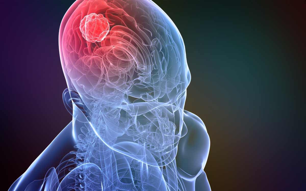 Рак мозга — Опухоль головного мозга (ОМГ): причины, симптомы, стадии,  сколько живут