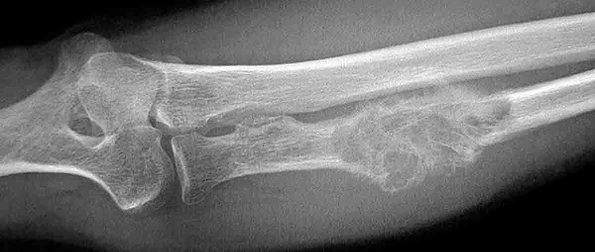 Рак кости ноги. Фибросаркома кости рентген. Хондросаркома кости рентген.