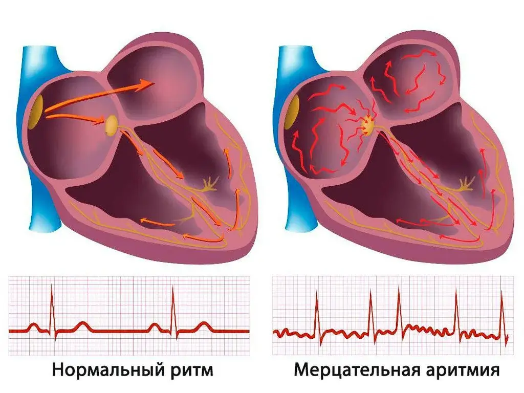 Учащённое сердцебиение (тахикардия). Причины, симптомы, лечение