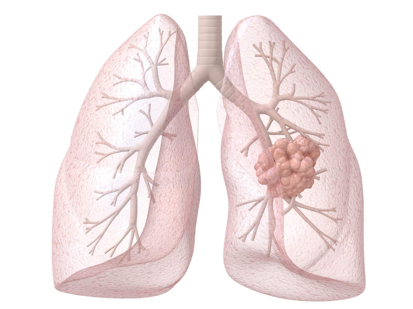 Основной симптом: Названы отличительные признаки кашля при раке легких