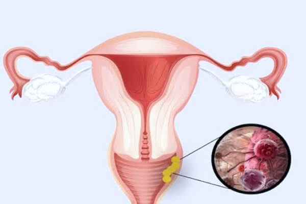 Воспалительные заболевания женских половых органов
